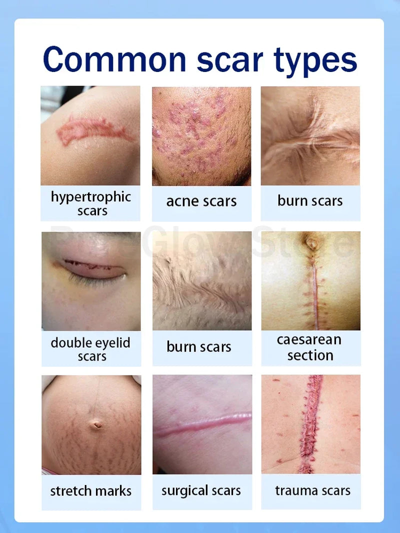 Solve Scar Problem Top Selling